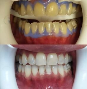 blanchiment dent agadir
