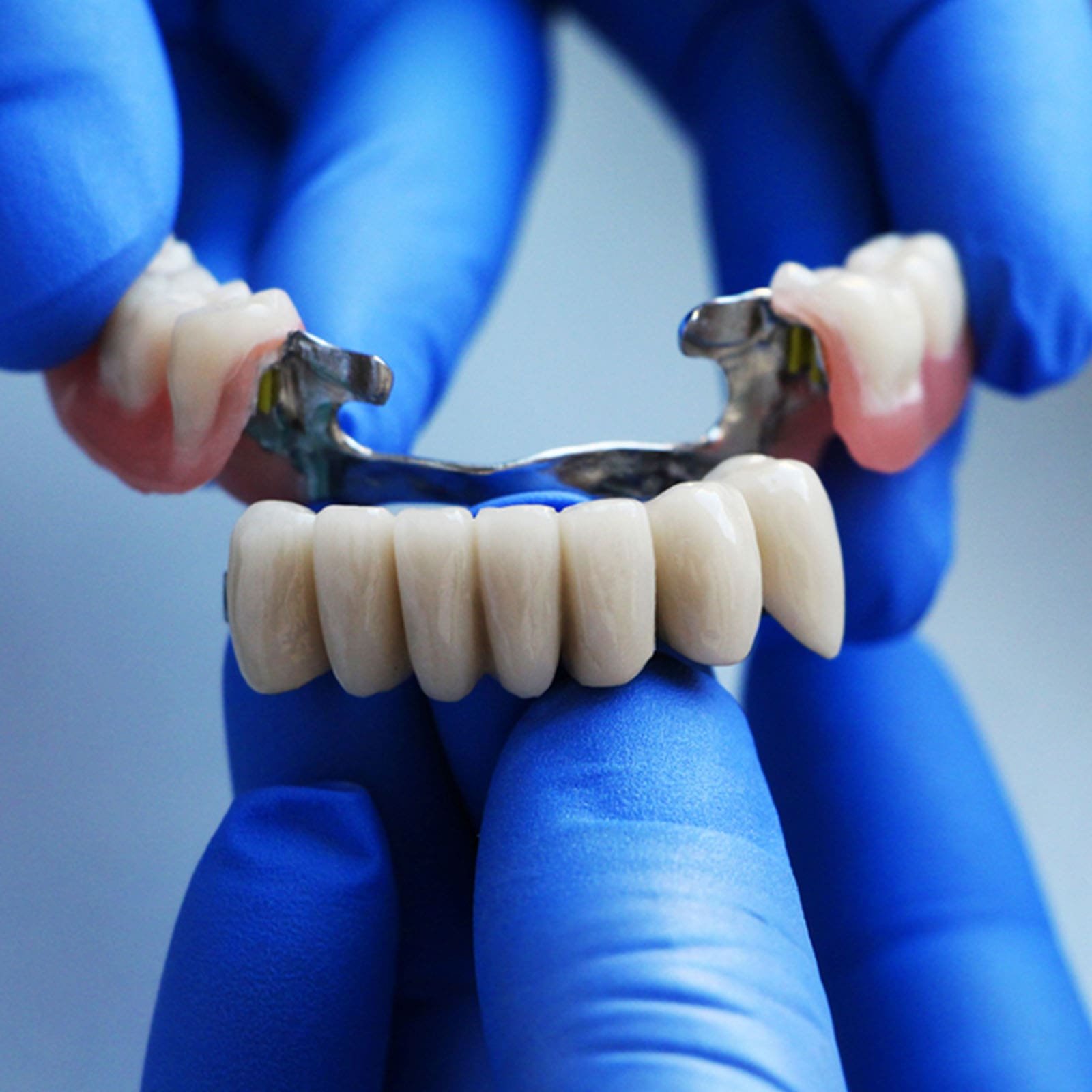 dental bridge