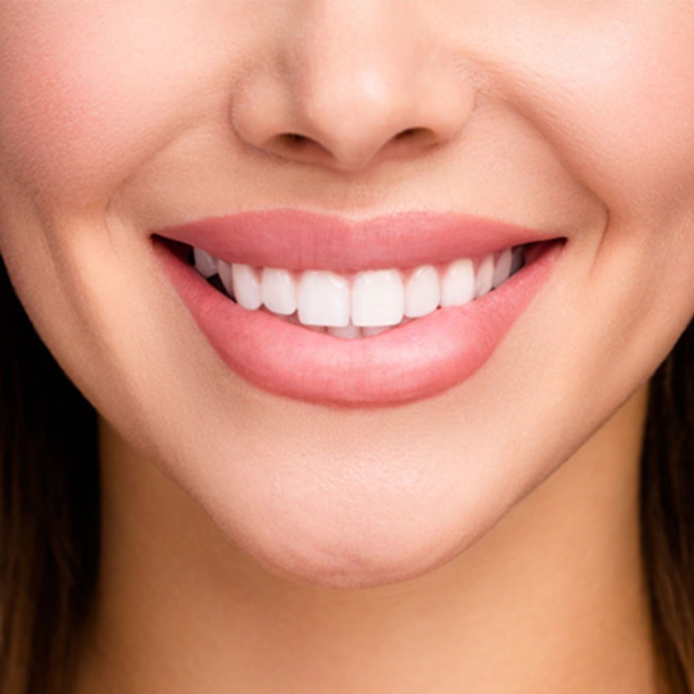 hollywood smile