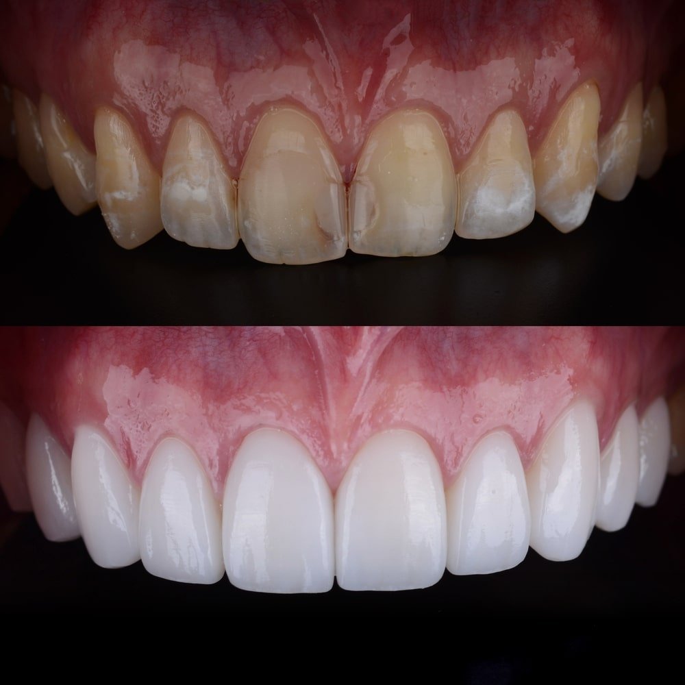 relooking du sourire